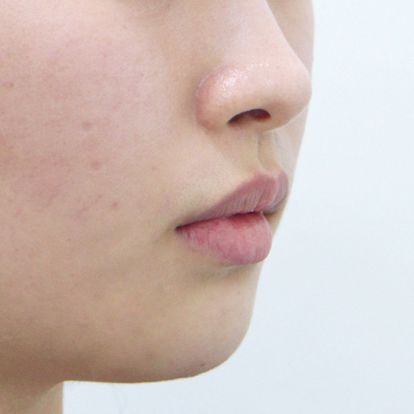 BL220402_Chin_2 before