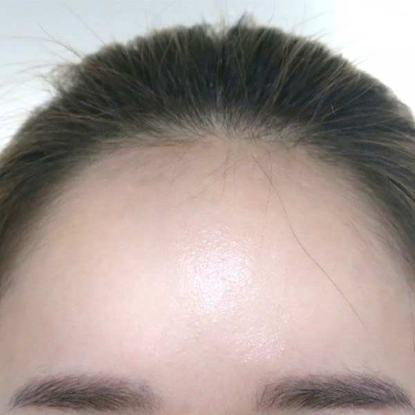 Forehead Type 2 _ After
