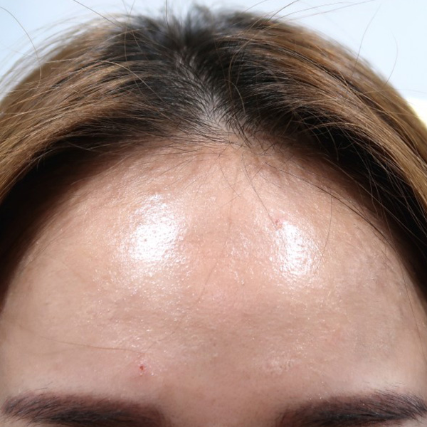 Forehead Type 2 _ Before