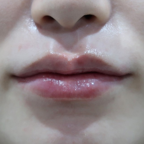 Lip_Type After