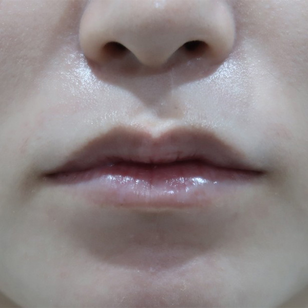 Lip_Type before