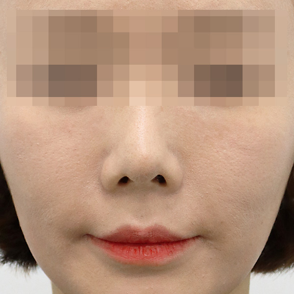 Royal_Cheek_type1 after