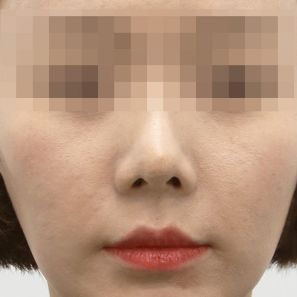 Royal_Cheek_type1 before