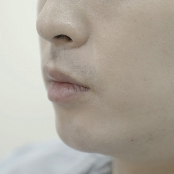 Royal_Chin_Type 2 After