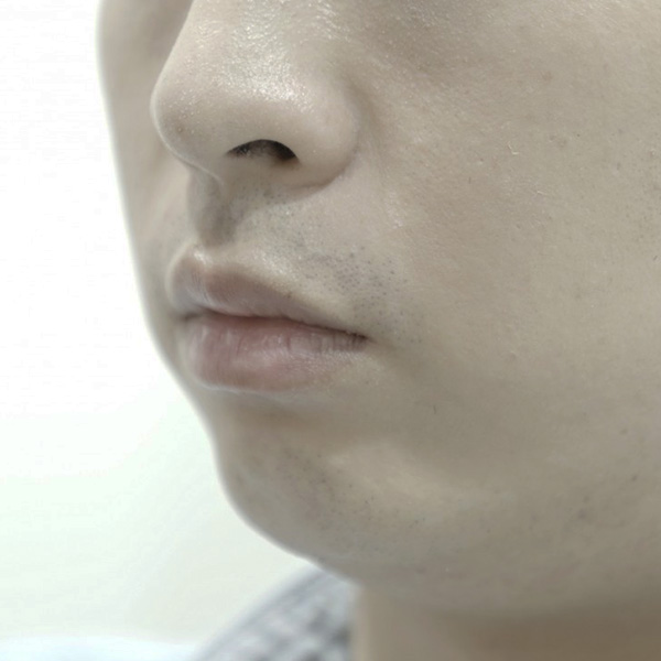 Royal_Chin_Type 2 before 2